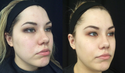 Dermal Fillers before and after photo