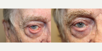 Eyelid Retraction Repair before and after photo