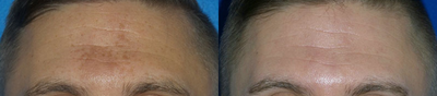 Halo Laser before and after photo