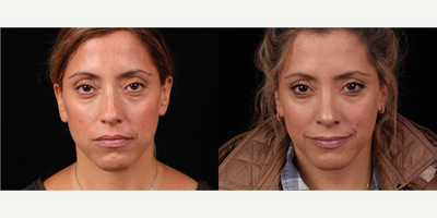 Rhinoplasty before and after photo