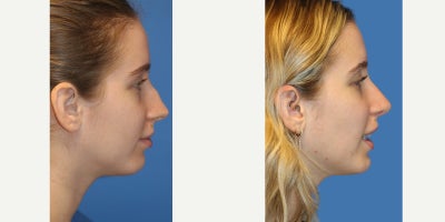 Rhinoplasty before and after photo