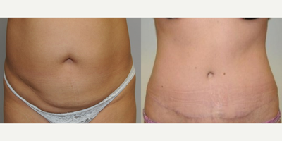 Tummy Tuck before and after photo