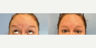 Dysport before and after photo