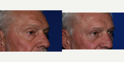Eyelid Surgery before and after photo