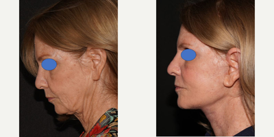Facelift Revision before and after photo