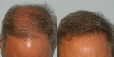 FUE Hair Transplant before and after photo