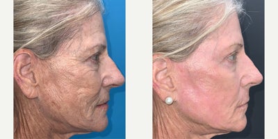Laser Resurfacing before and after photo
