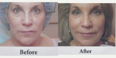 Liquid Facelift before and after photo