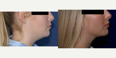 Neck Lift before and after photo