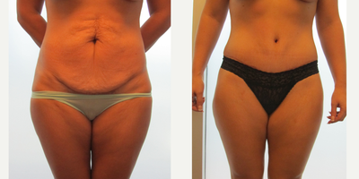 Tummy Tuck before and after photo