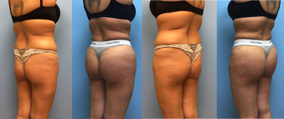 Brazilian Butt Lift before and after photo