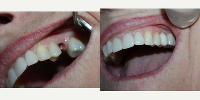 Dental Implants before and after photo