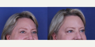 Dysport before and after photo