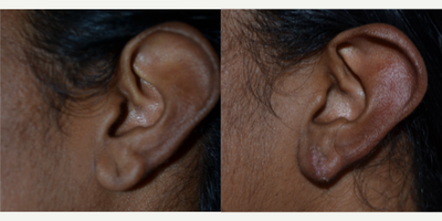 Ear Surgery before and after photo