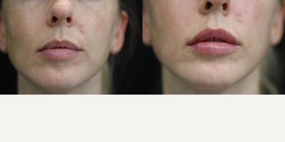 Lip Fillers before and after photo