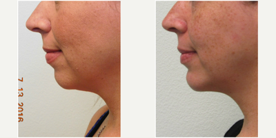 Chin Liposuction before and after photo