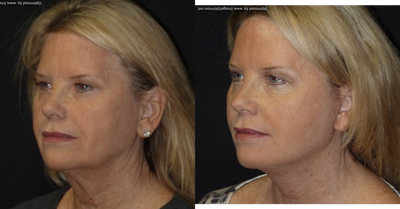 Facelift before and after photo