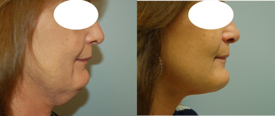 Facelift before and after photo