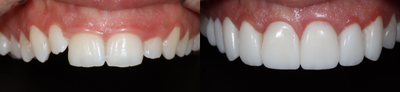 Gum Lift before and after photo