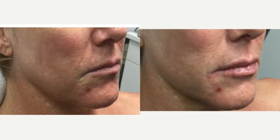 Lip Fillers before and after photo