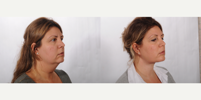 Neck Lift before and after photo