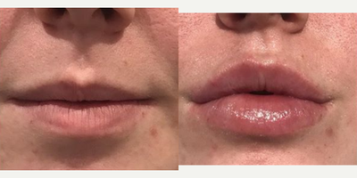 Restylane before and after photo