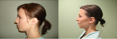 Rhinoplasty before and after photo