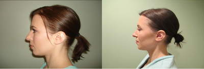 Rhinoplasty before and after photo