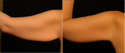 Arm Lift before and after photo