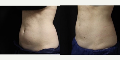 CoolSculpting before and after photo