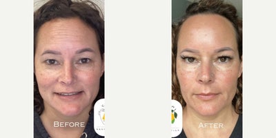Microneedling before and after photo