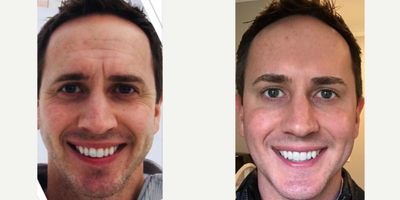 Botox before and after photo