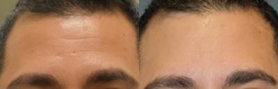 Botox before and after photo