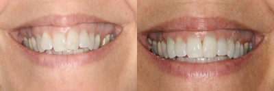 Invisalign before and after photo