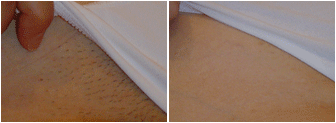 Laser Hair Removal before and after photo