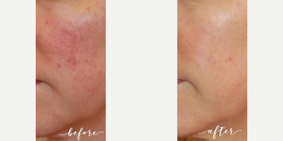 Laser Resurfacing before and after photo