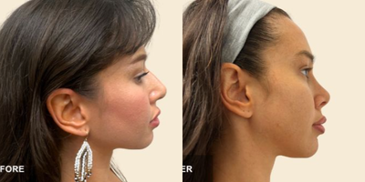 Rhinoplasty before and after photo