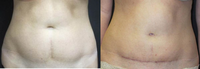 Tummy Tuck before and after photo