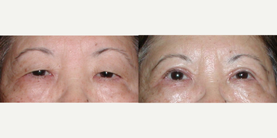 Eyelid Surgery before and after photo