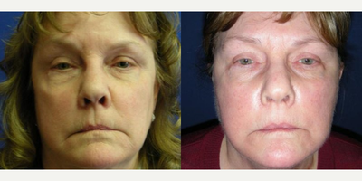 Facelift before and after photo