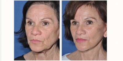 Facial Fat Transfer before and after photo