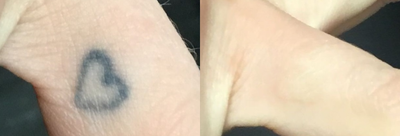Tattoo Removal before and after photo