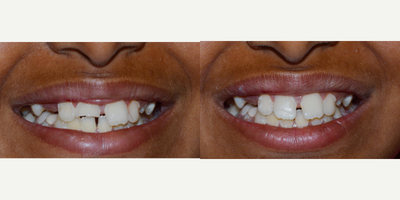 Tooth Repair before and after photo