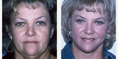 Facelift before and after photo