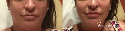 Volbella before and after photo