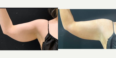 BodyTite before and after photo