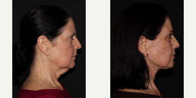 Brow Lift before and after photo