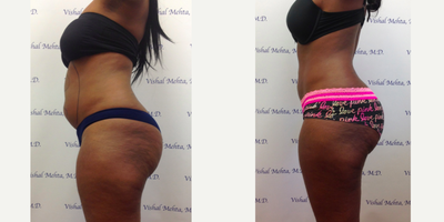 Laser Liposuction before and after photo
