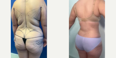 Renuvion before and after photo