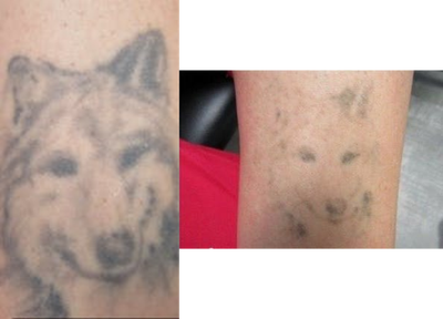 Tattoo Removal before and after photo